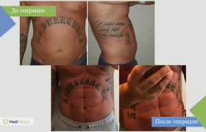 липосакция all inclusive фото до после