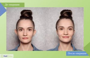 отопластика до и после фото