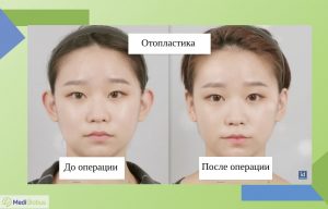 отопластика фото до и после операции корея id hospital