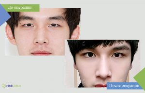 отопластика до и после фото корея