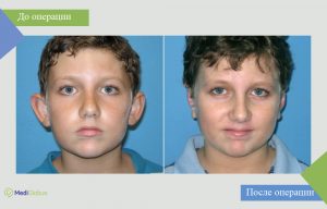 отопластика у детей фото до после