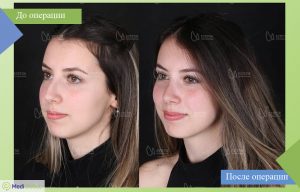 ринопластика all inclusive фото до после