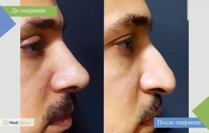 ринопластика all inclusive фото до после