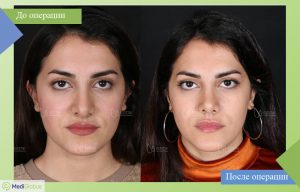 ринопластика all inclusive фото до после