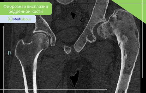 фиброзная дисплазия бедренной кости кт