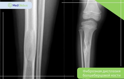 фиброзная дисплазия большеберцовой кости рентген лечение