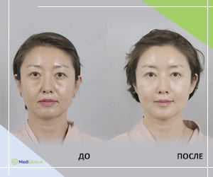Фото до и после липофилинга в клинике ID Hospital в Южной Корее