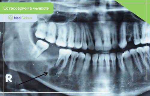 остеосаркома челюсти у детей радиография