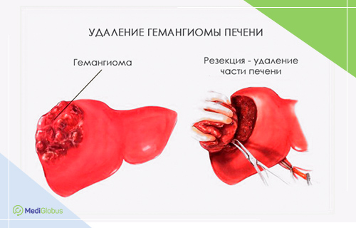 Кавернозная гемангиома печени лечение хирургия операция