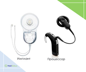 Виды, цена, клиники Кохлеарная имплантация