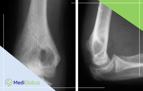 симптомы костной кисты